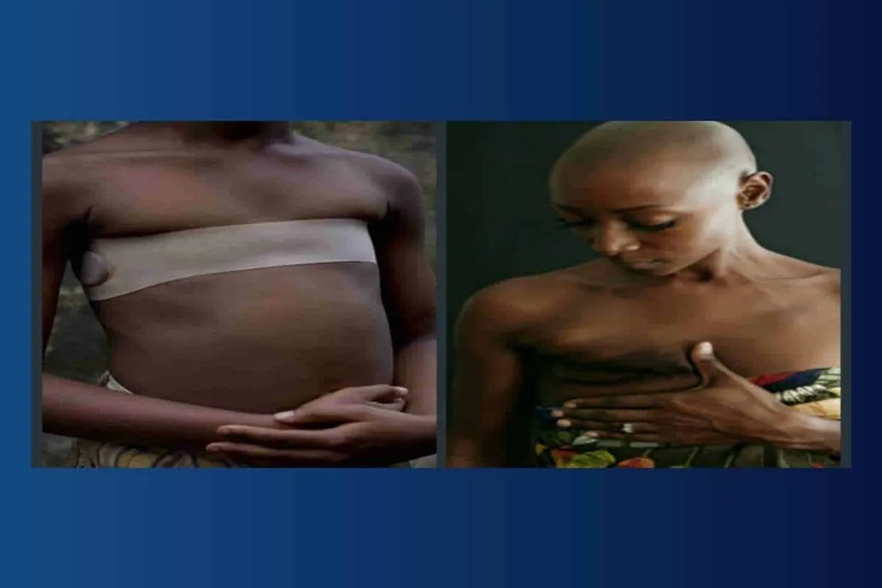 breast flattening