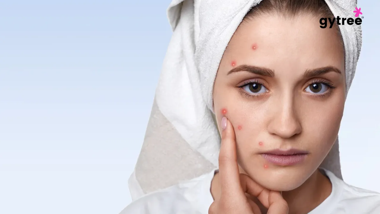 Is your acne indicating any underlying health issue?
