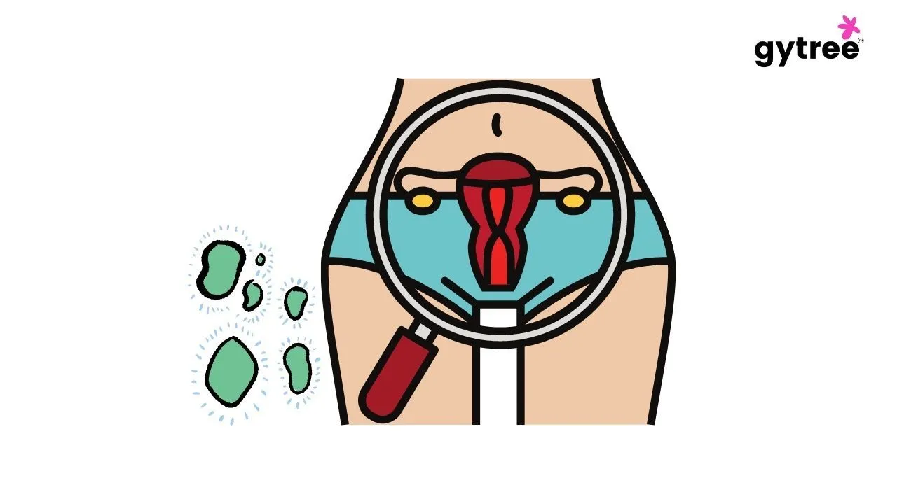 Bacterial vaginosis and it’s symptoms