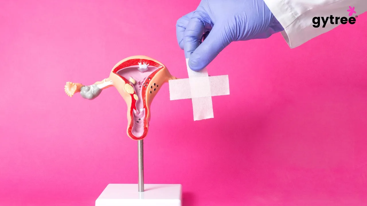 What is endometriosis?