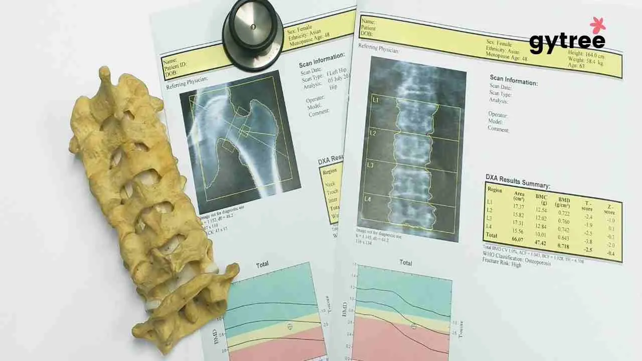 How to prevent osteoporosis