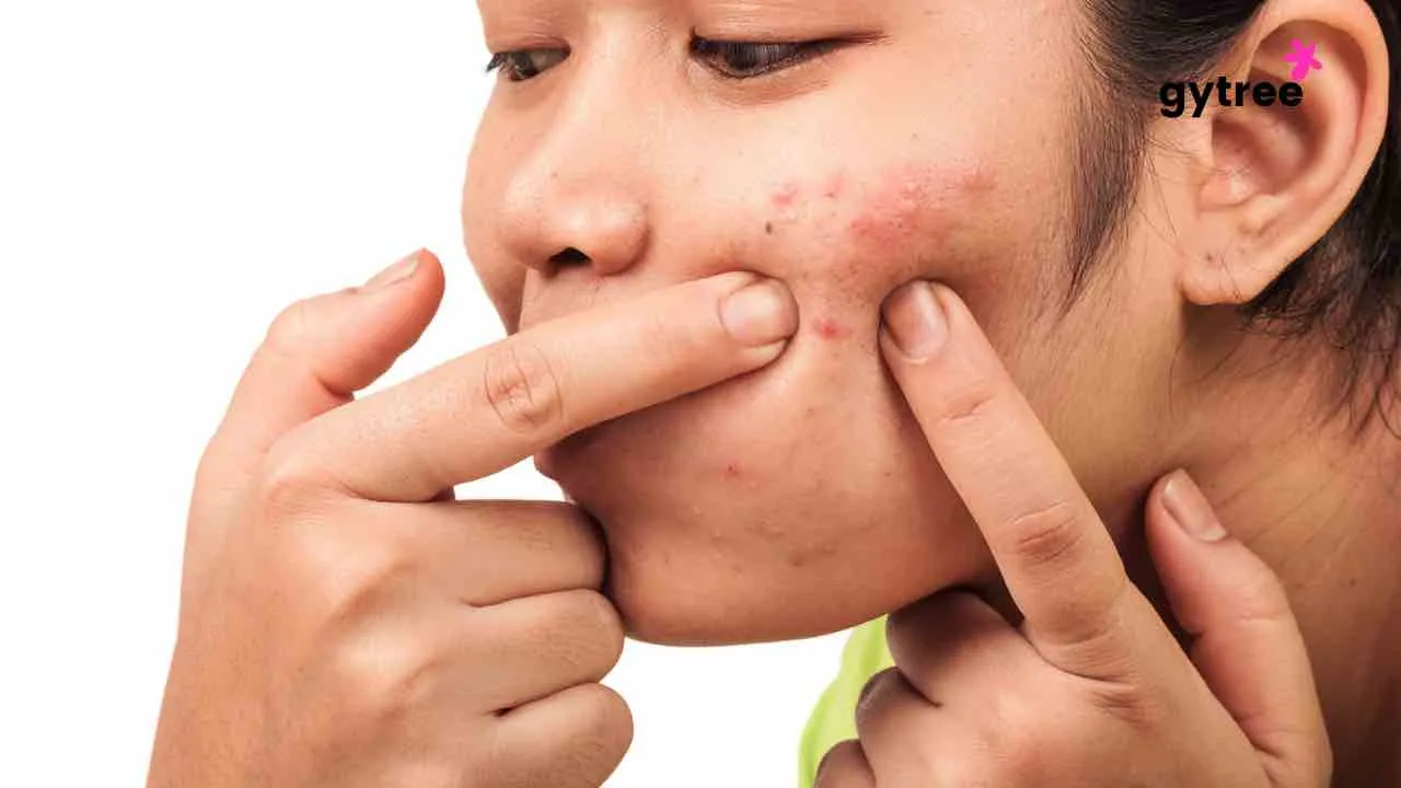 Stress and acne