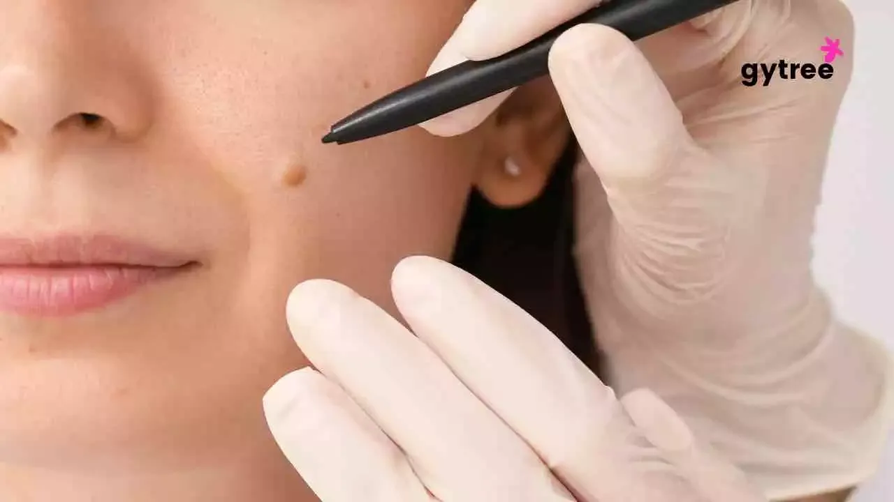 Moles: When to get concerned about them?