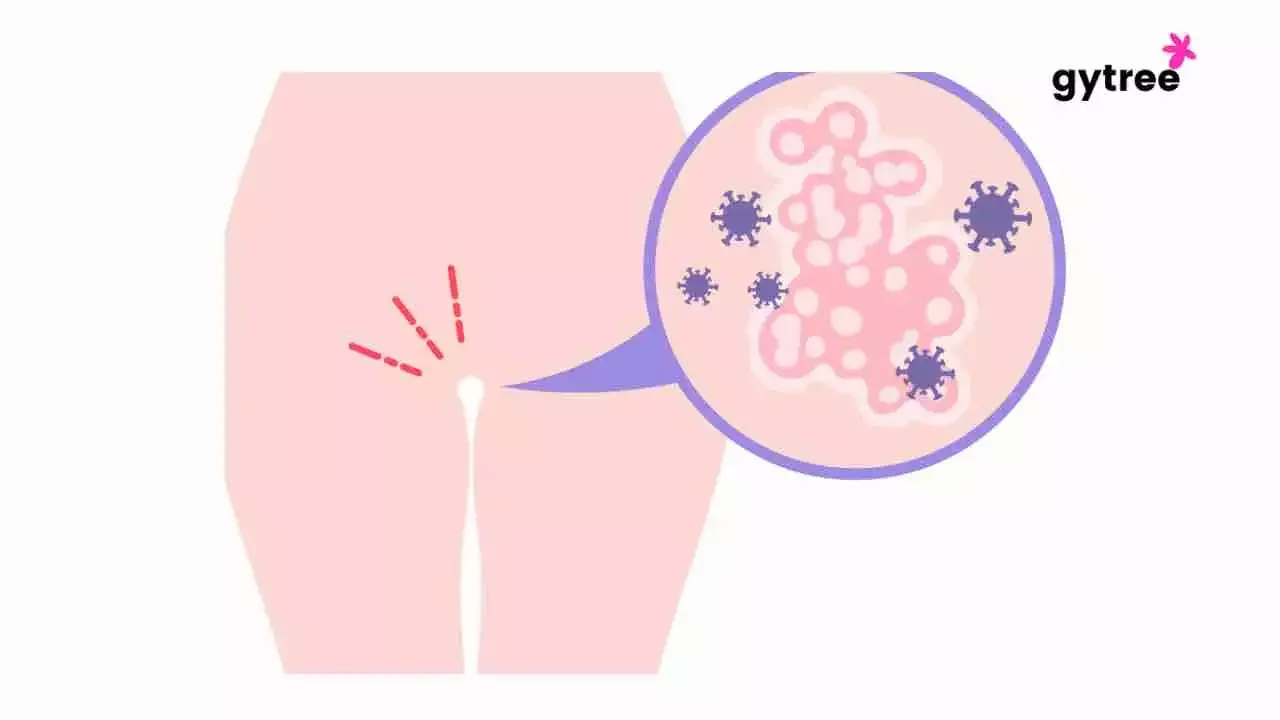 Understanding the Types of Genital Warts in Women