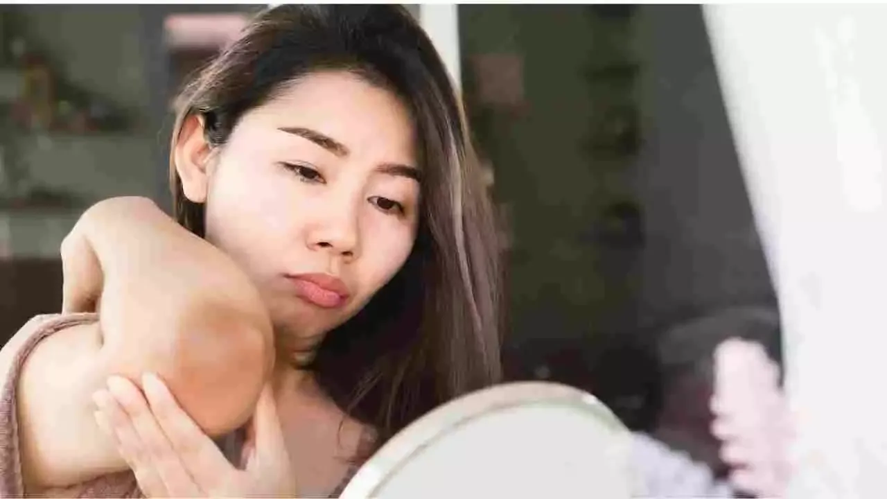 Got Dark Elbows? 8 home remedies that work!