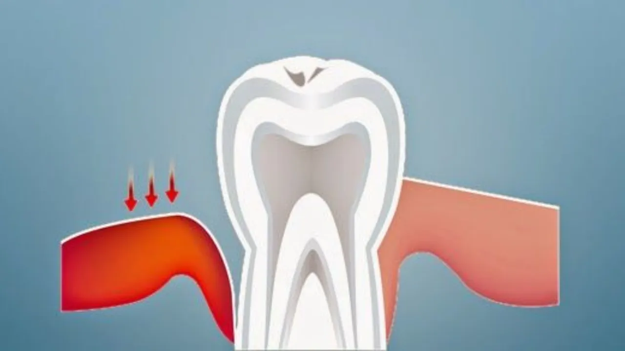 How To Reduce Pyorrhoea In Teeth