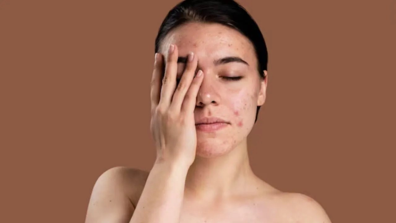 acne care tips