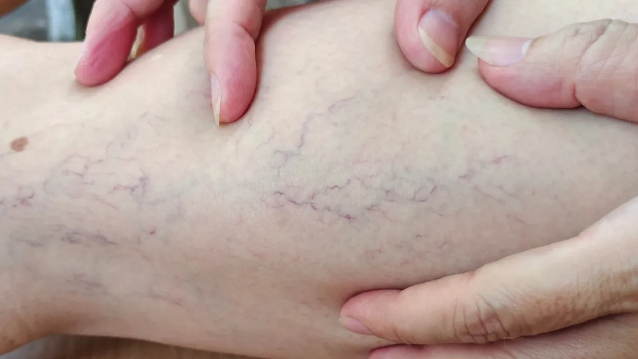 veins