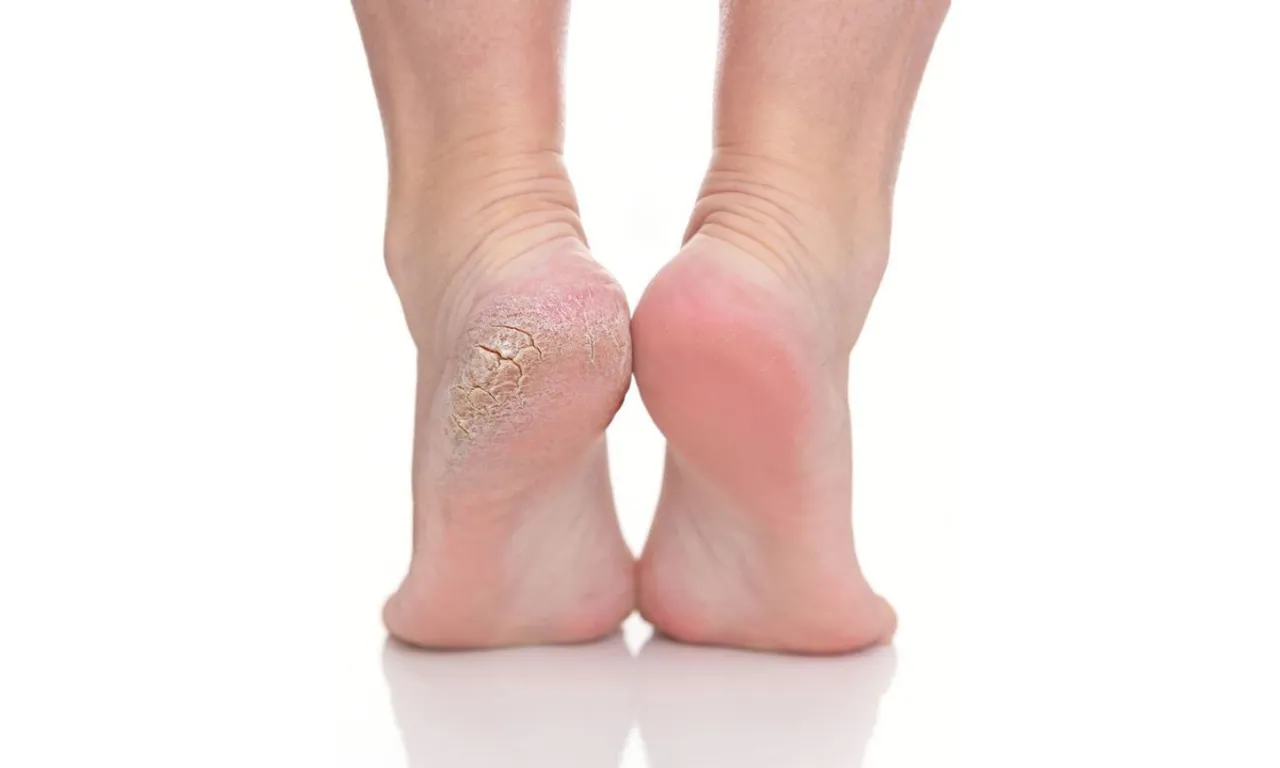 5 best solutions to soften your cracked heels
