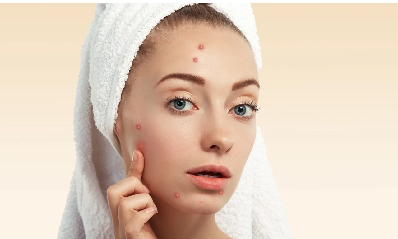 Pimple