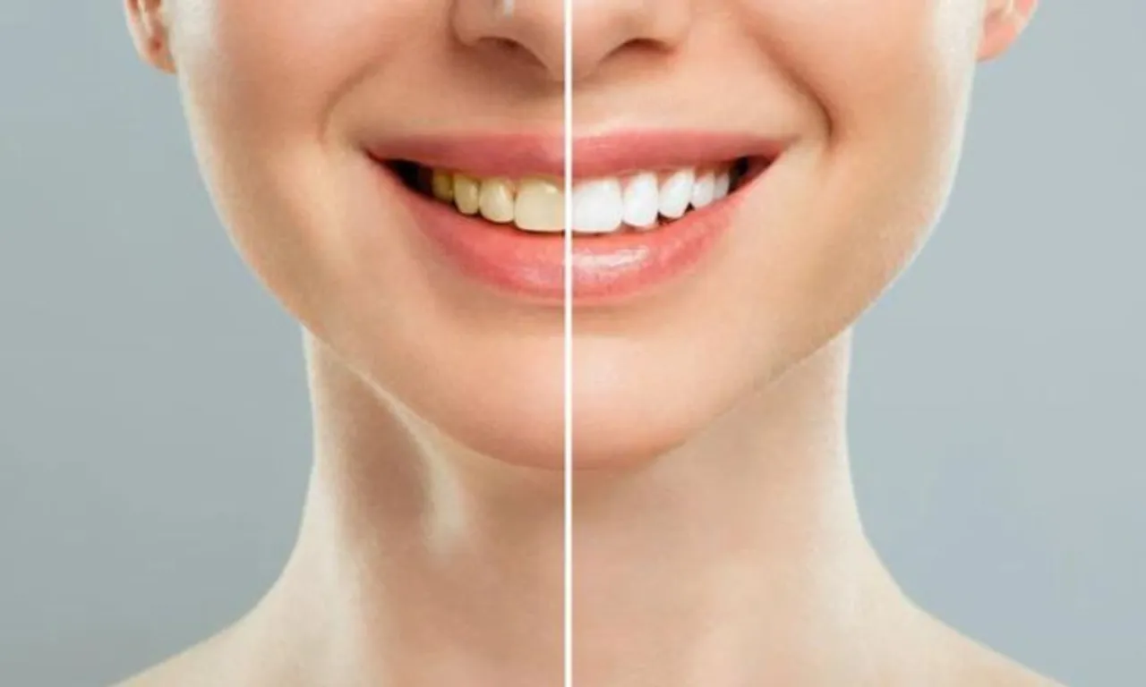 To Get Rid Of Yellowing Of Teeth, Follow These 5 Home Remedies