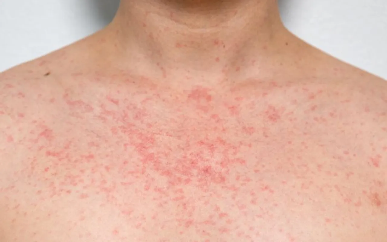 HEAT RASH