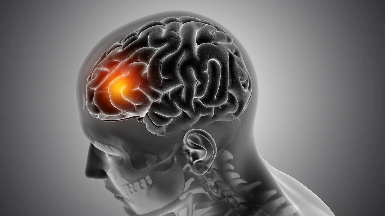What Is The Reason Behind Brain Hemorrhage
