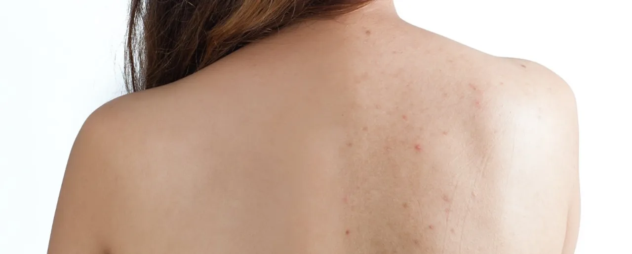 Body Acne