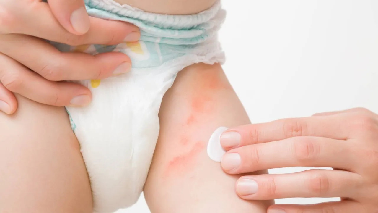 Diaper rash 