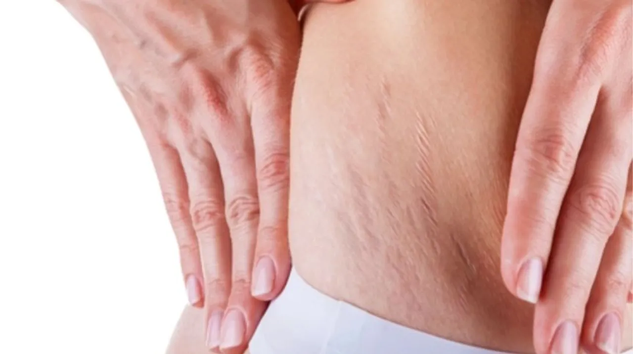 Home remedies for stretch marks 