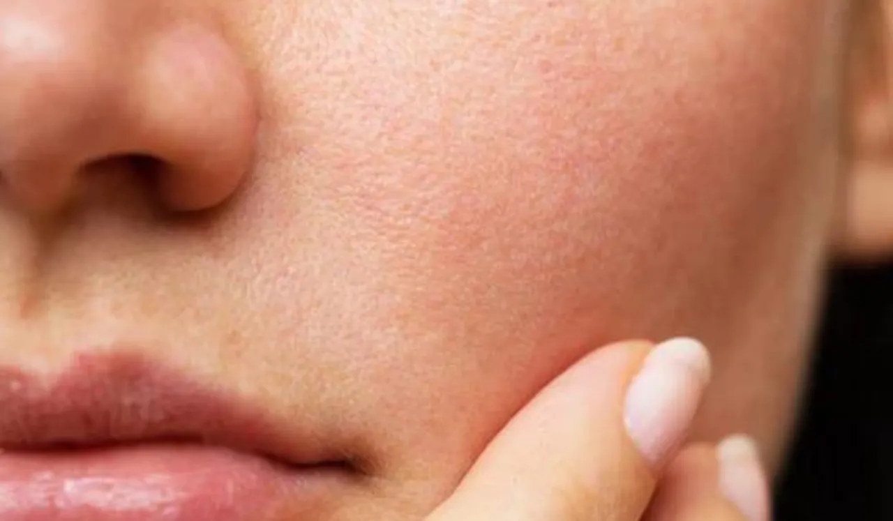Open Pores(SkinCraft)