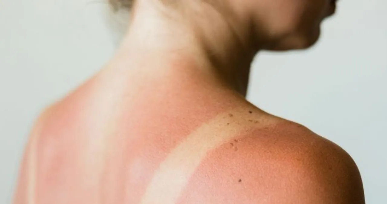 Sun Exposure 