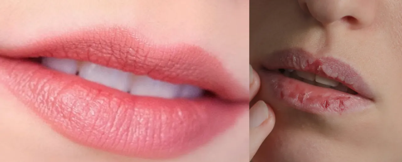 Lip care