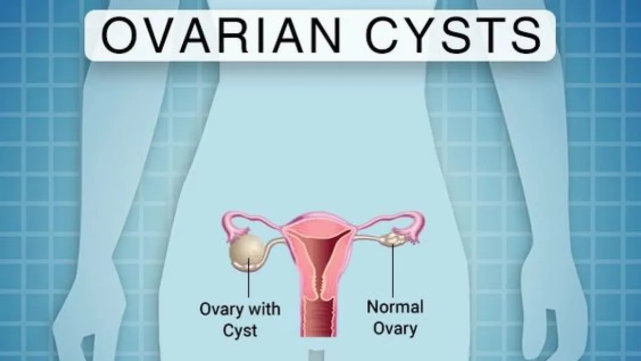 Cyst (Pinterest).png