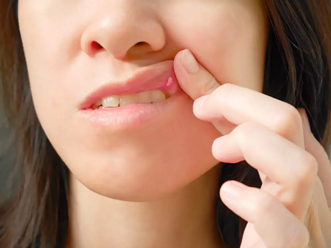 ulcer