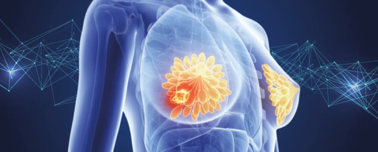 Breast Cancer img.png