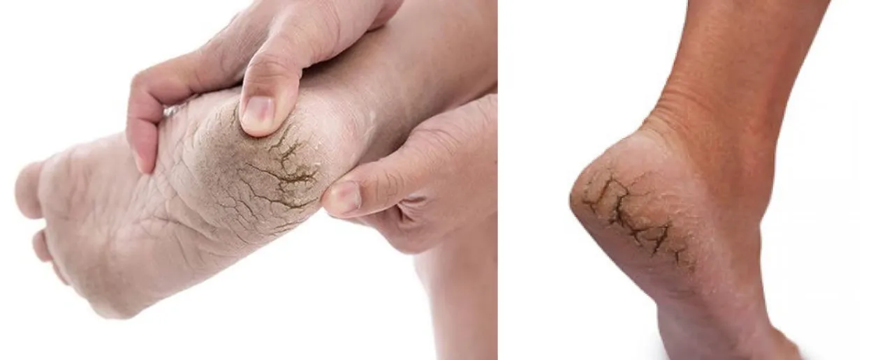 Cracked Heels