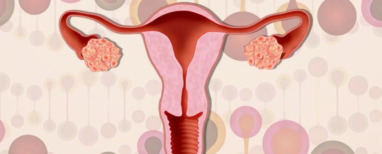 Myths of PCOS.png