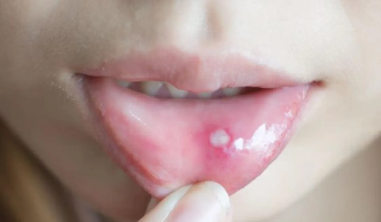 How To Treat Mouth Blisters At Home 