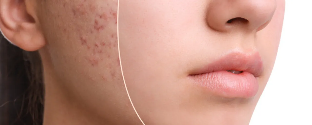 Acne Spots