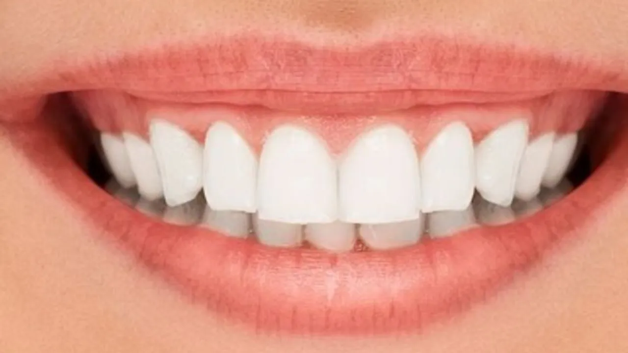 Teeth whitening 