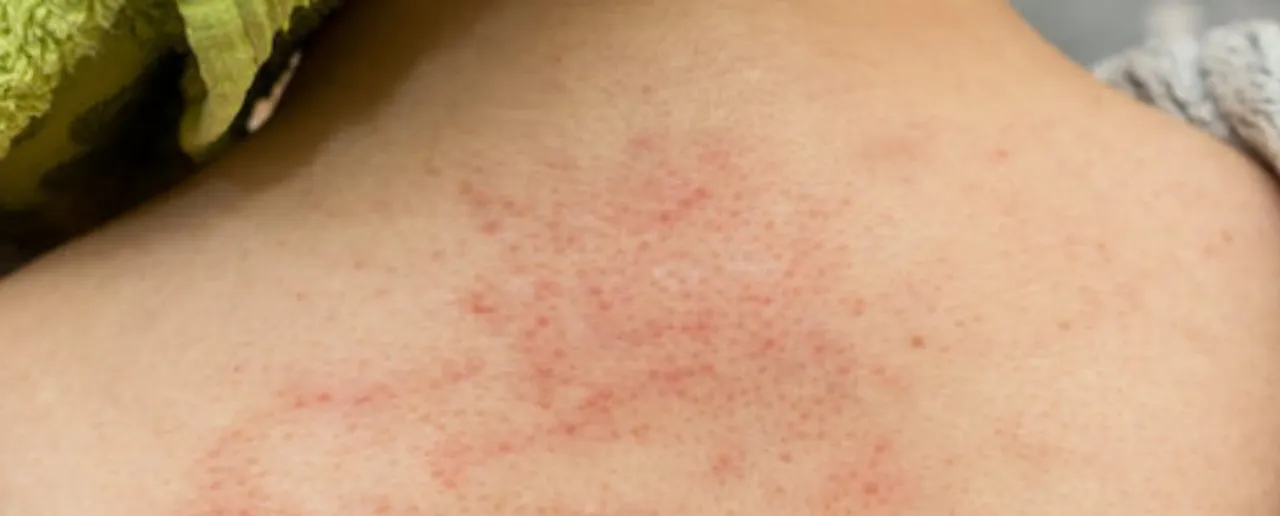 Heat Rash