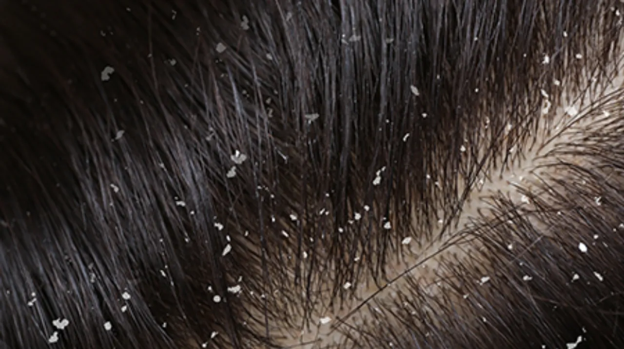 home remedies for dandruff 