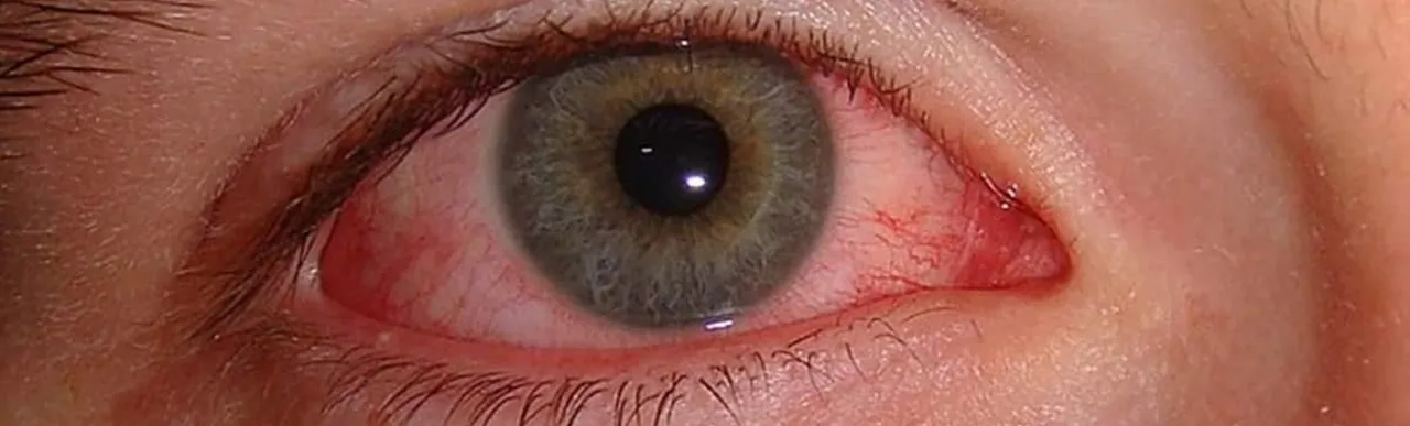 Symptom 0000.png