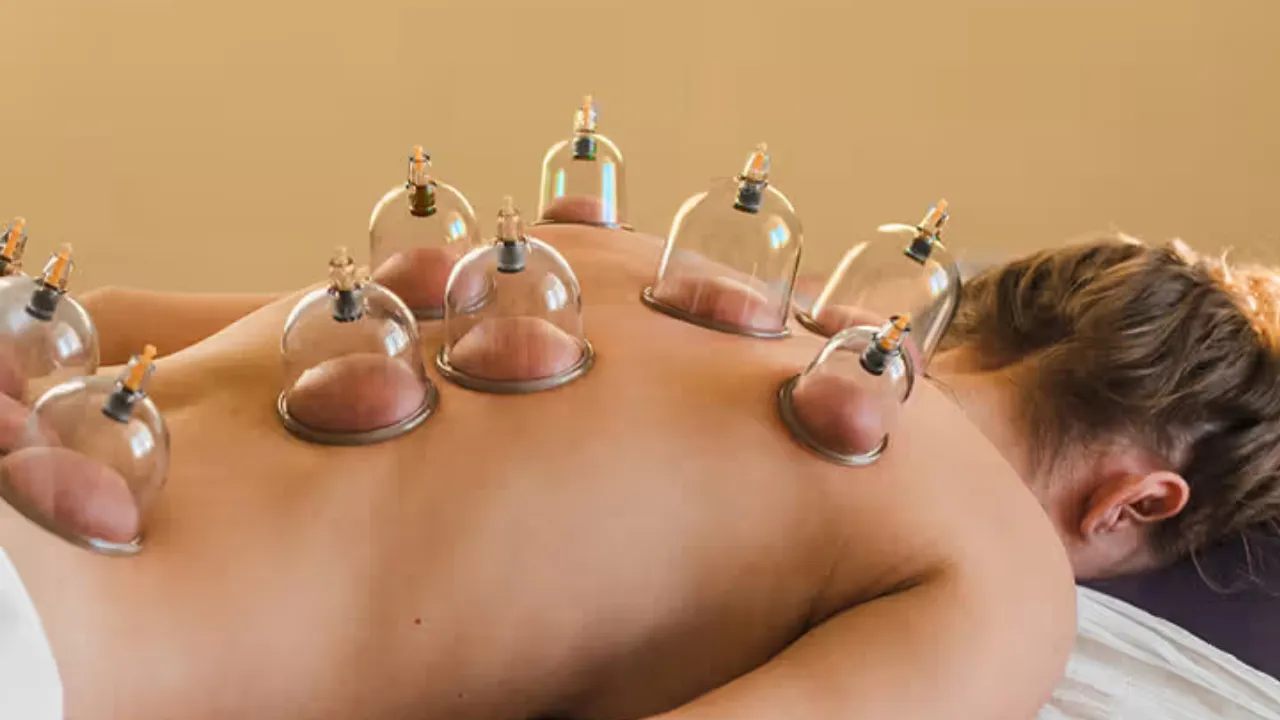 cupping therapy