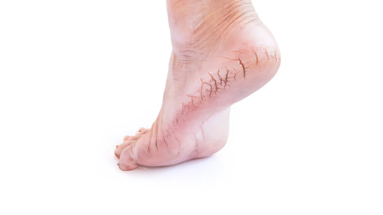 Cracked Heels (Healthlekh.com).png