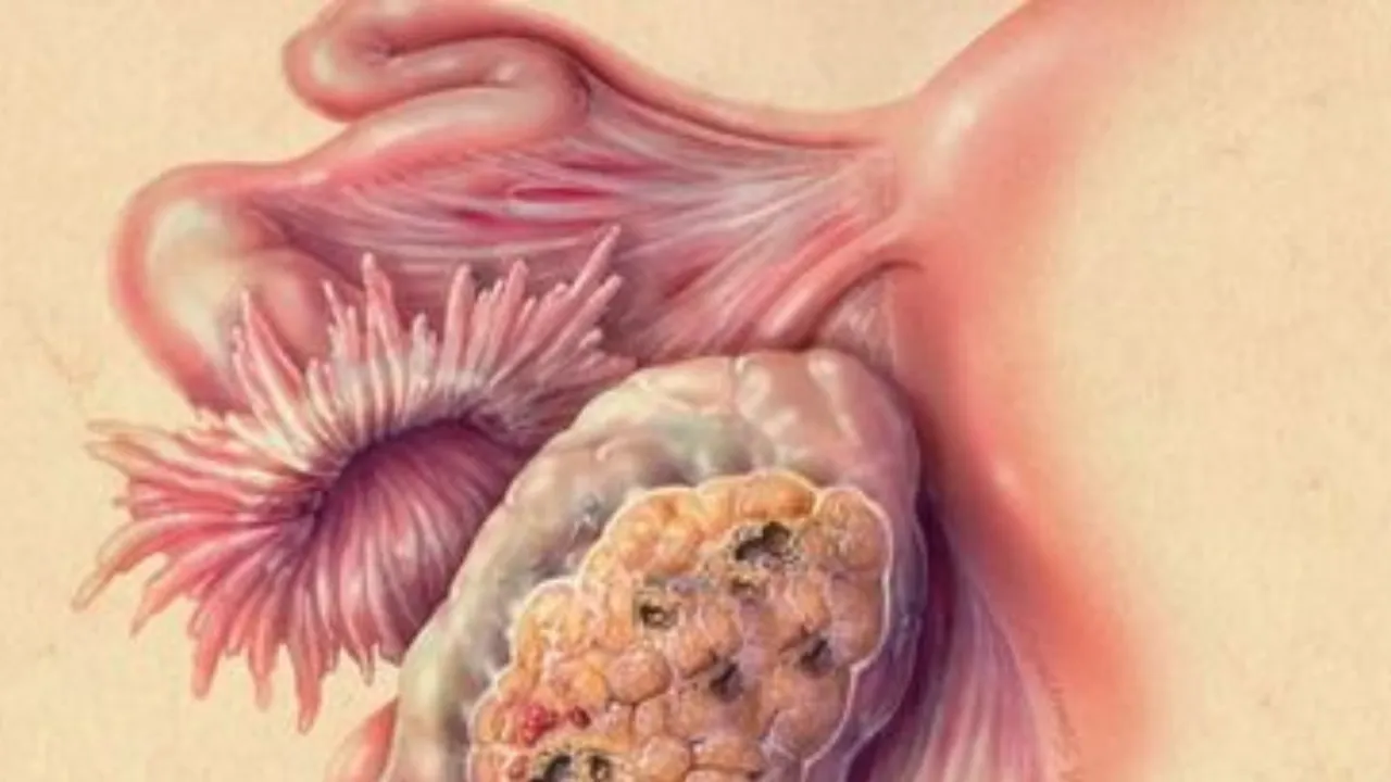 What Is Ovarian Cancer And It's Symptoms