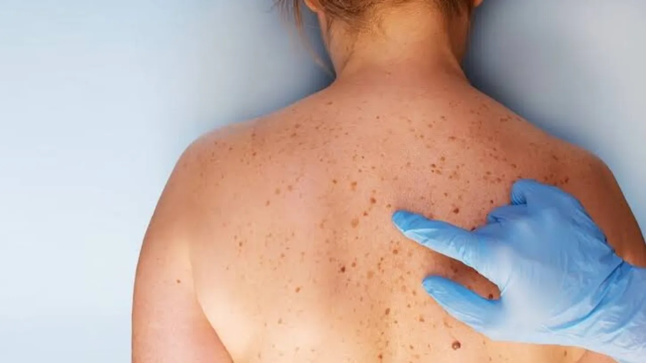 Symptoms of skin cancer