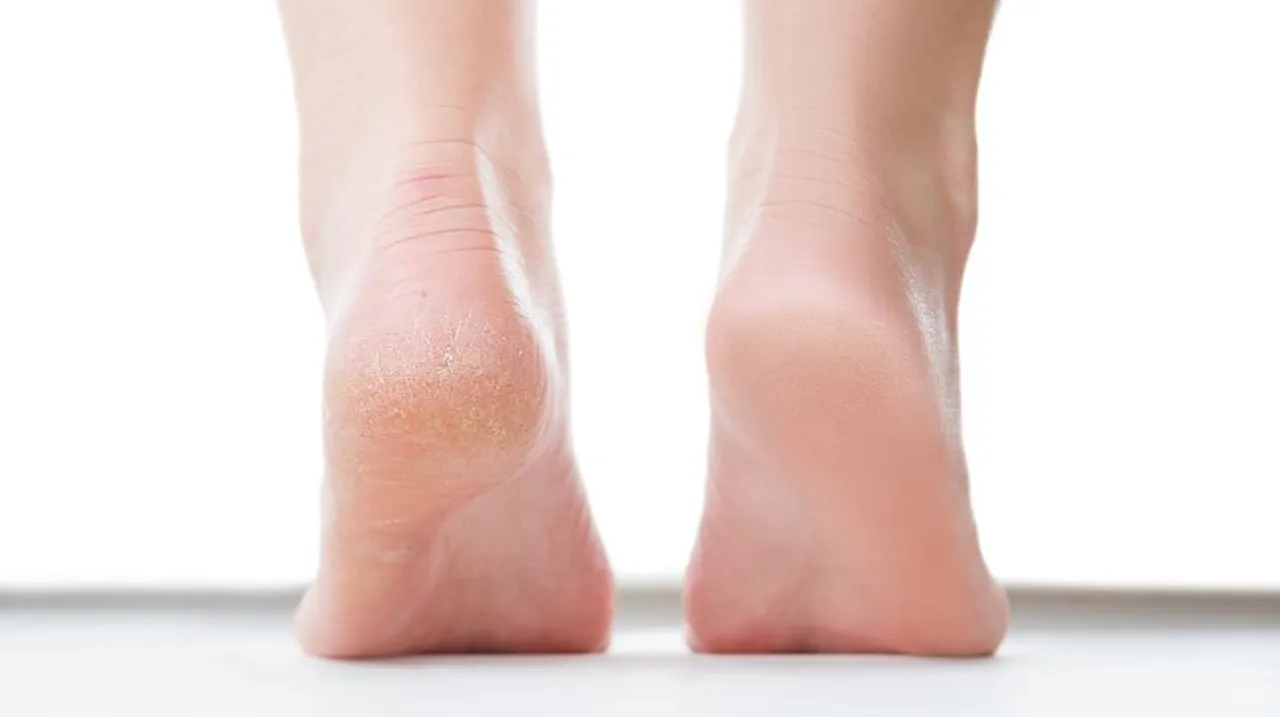 cracked heels