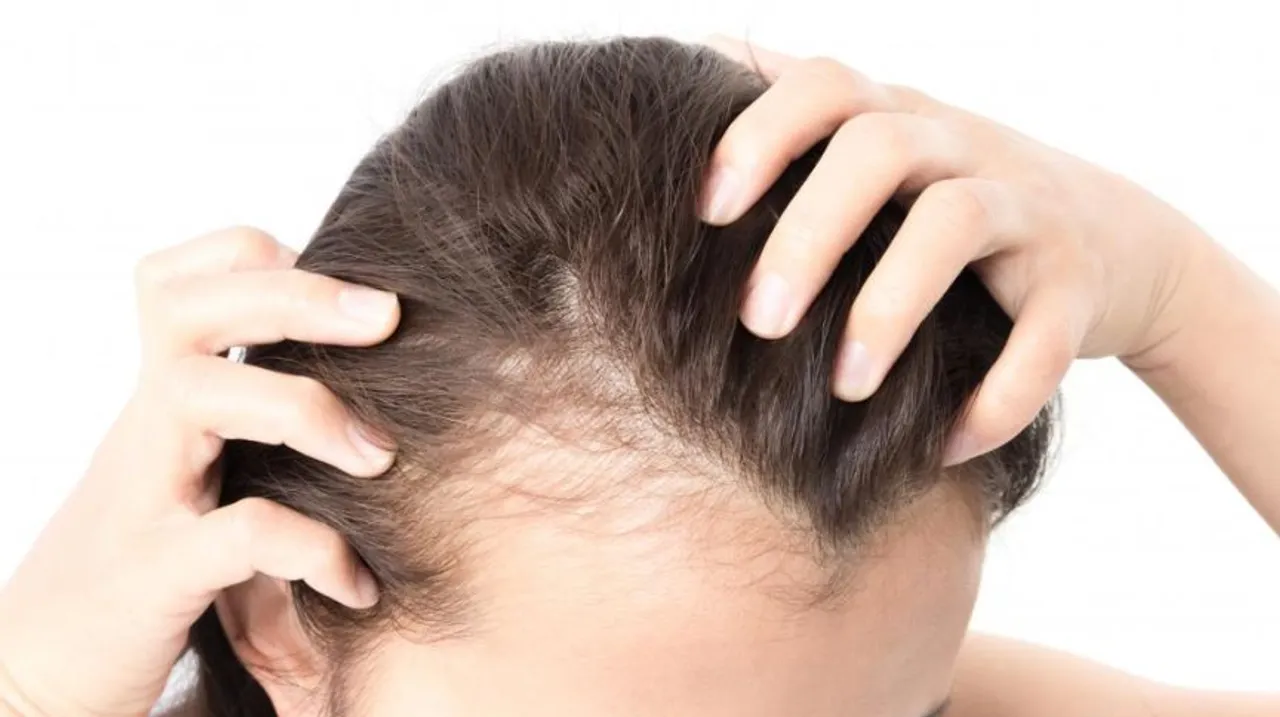 Female Pattern Baldness