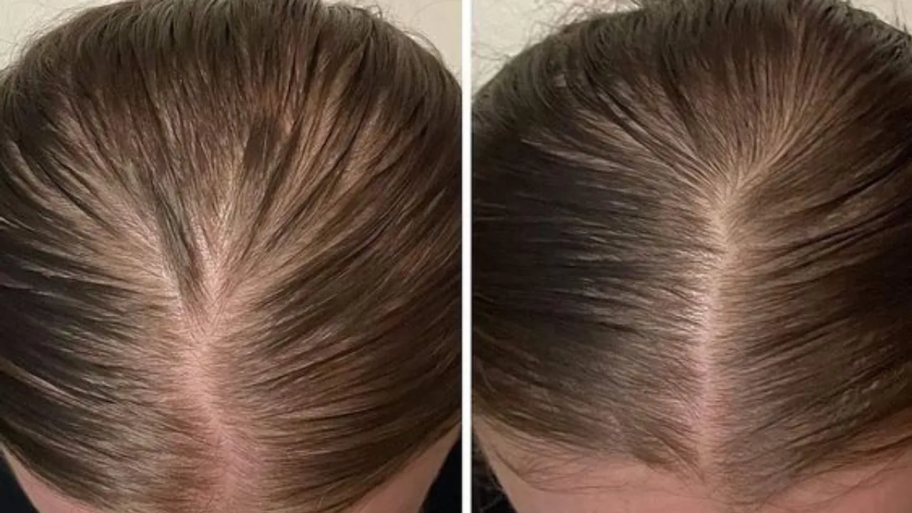 Baldness (Pinterest).png