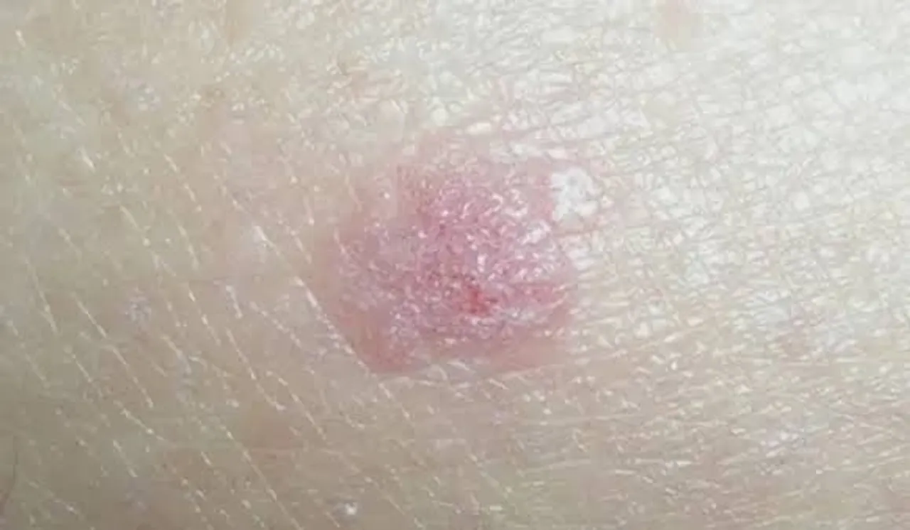 Itching 
