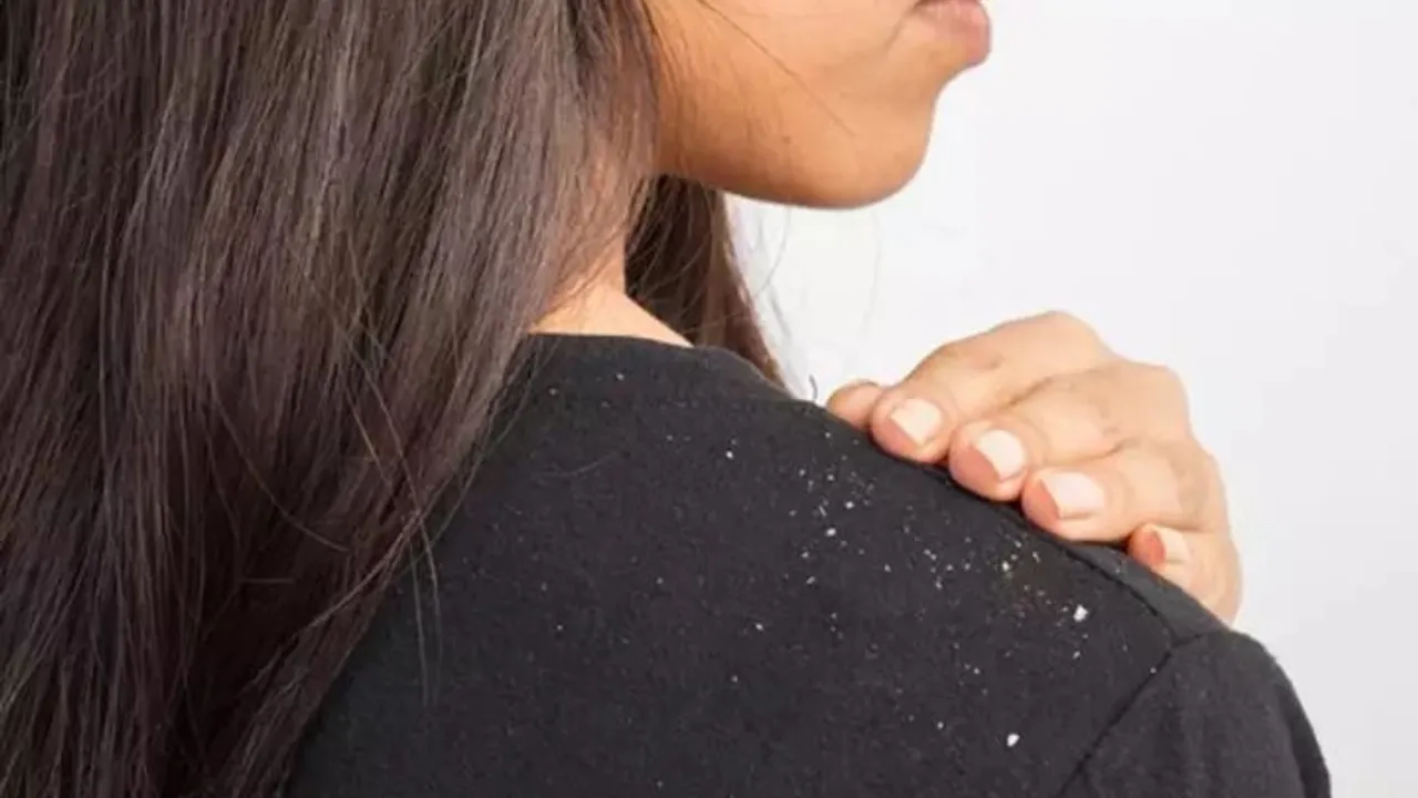 Dandruff issues 