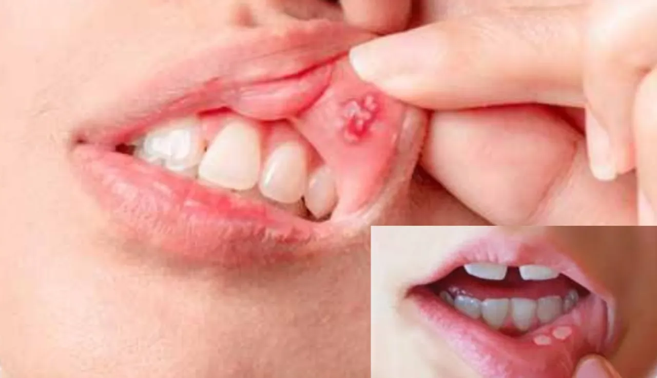 Ulcers