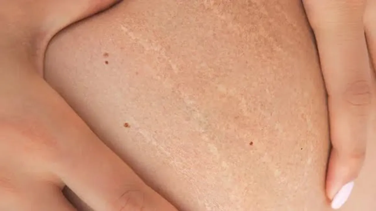Stretch Marks