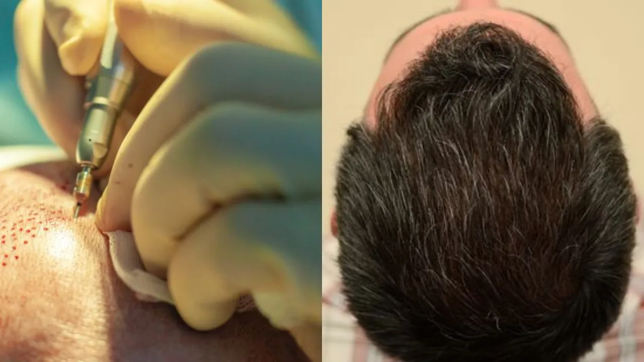 problems may occur after hair transplantation