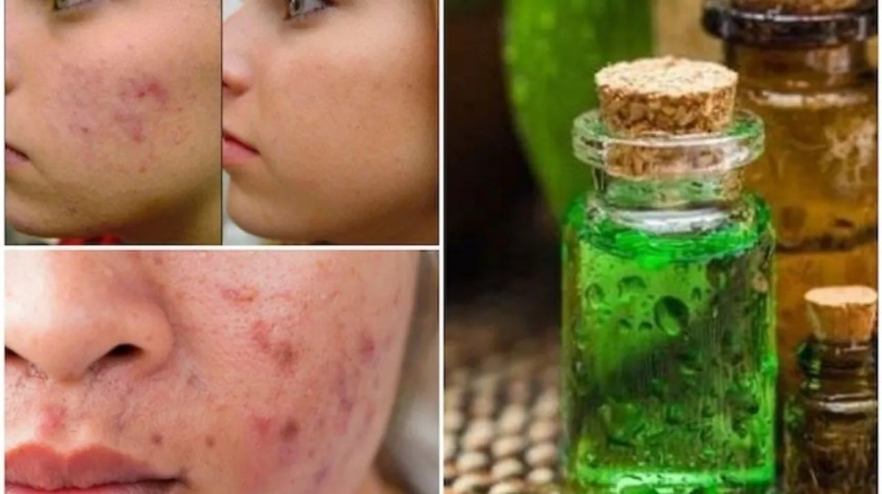 tea tree oil 