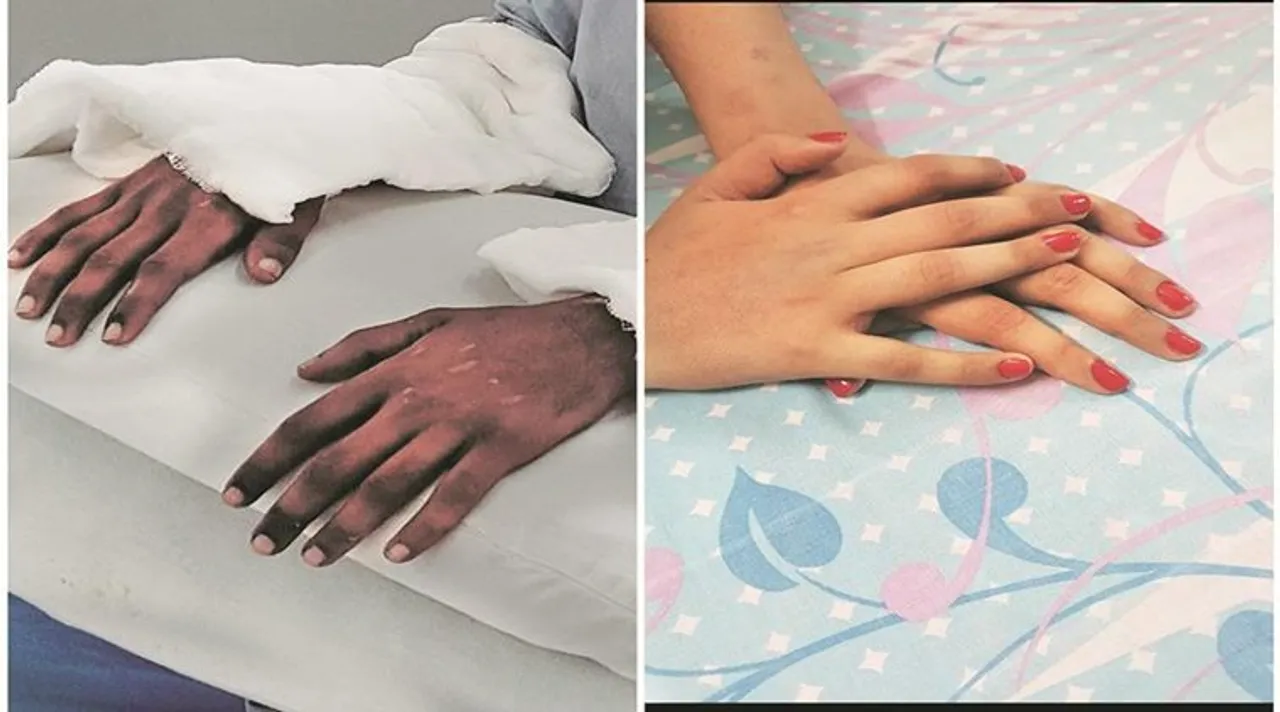 Hand transplant