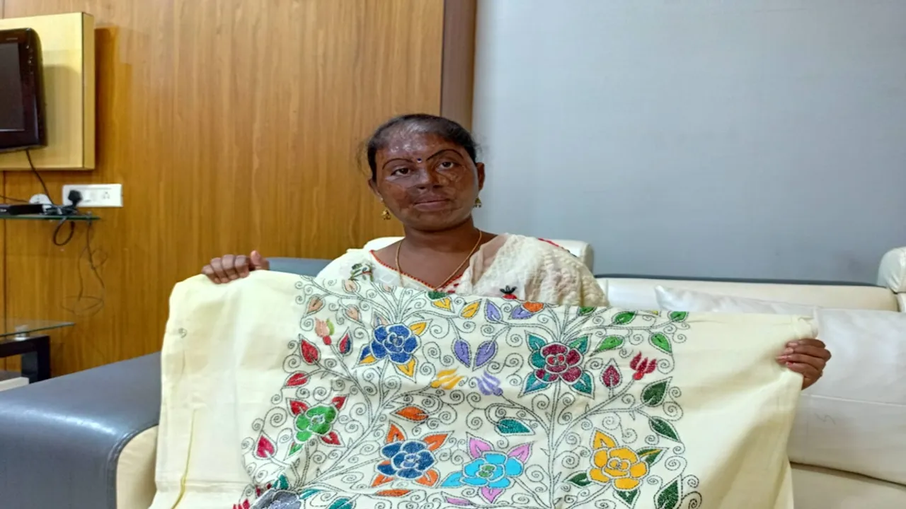 jhuma pandit chaterjee acid burns bhedia east burdwan