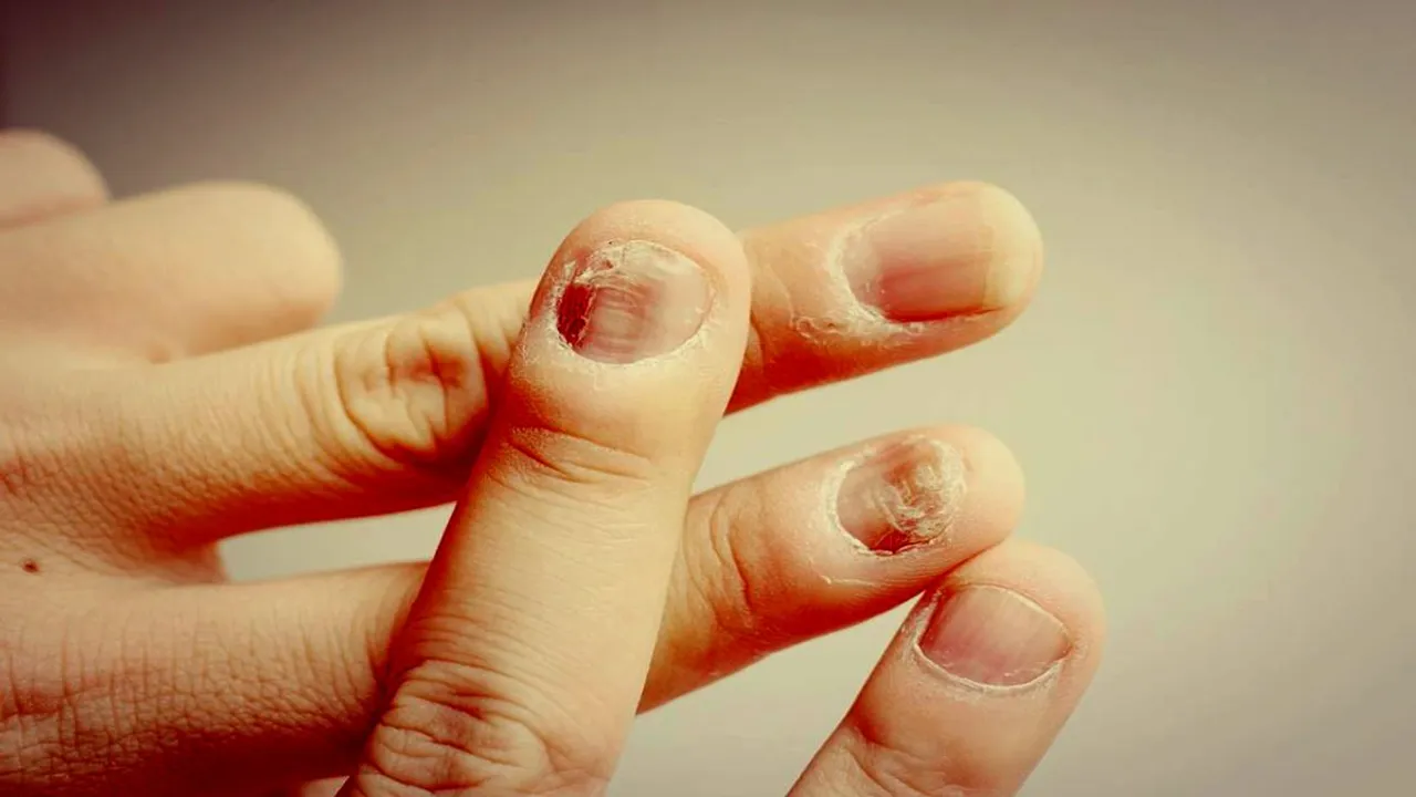 nail infection - ayurveda - cure